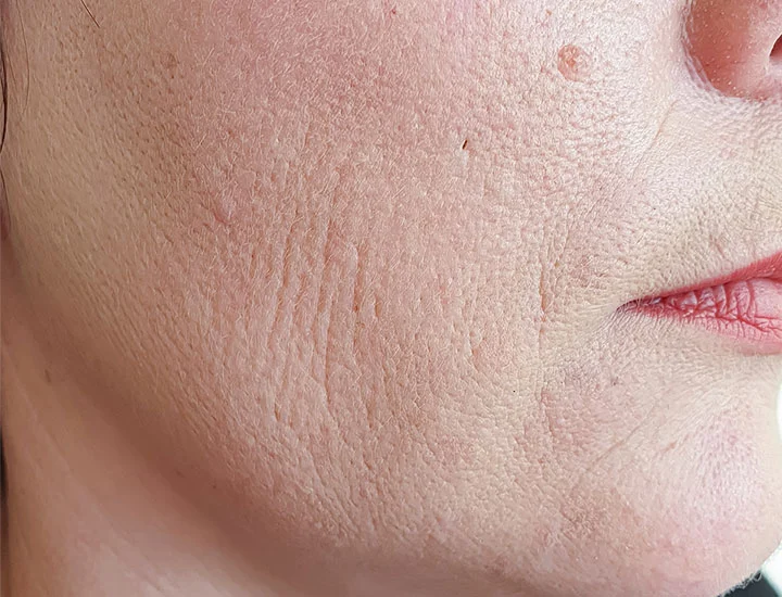 How to Tell If Your Skin Is Dehydrated (Not Dry)